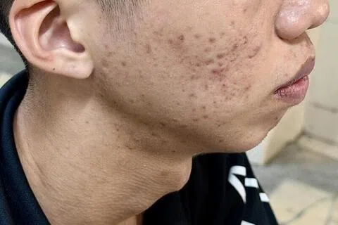 陈先生说，一心想改善脸部痘疤，才听信职员的话，签下配套。（曾美玲摄）