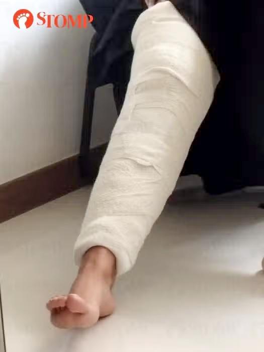 女子到医院求医,受伤的右脚被包扎,医生也给予14天病假。(取自STOMP)