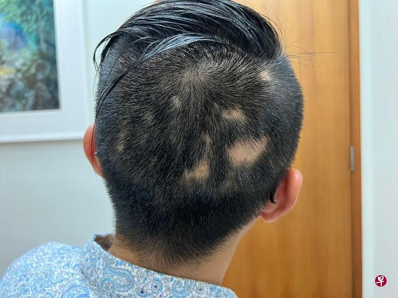 ←↑患者头部会突然出现圆形或椭圆形的秃发斑，毛囊口清晰可见。