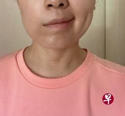 40岁行政助理本月初被诊断患上拉姆齐亨特综合征，如今已经进入康复期但还是无法控制左脸的肌肉，微笑时左边嘴角不能上扬。（受访者提供）