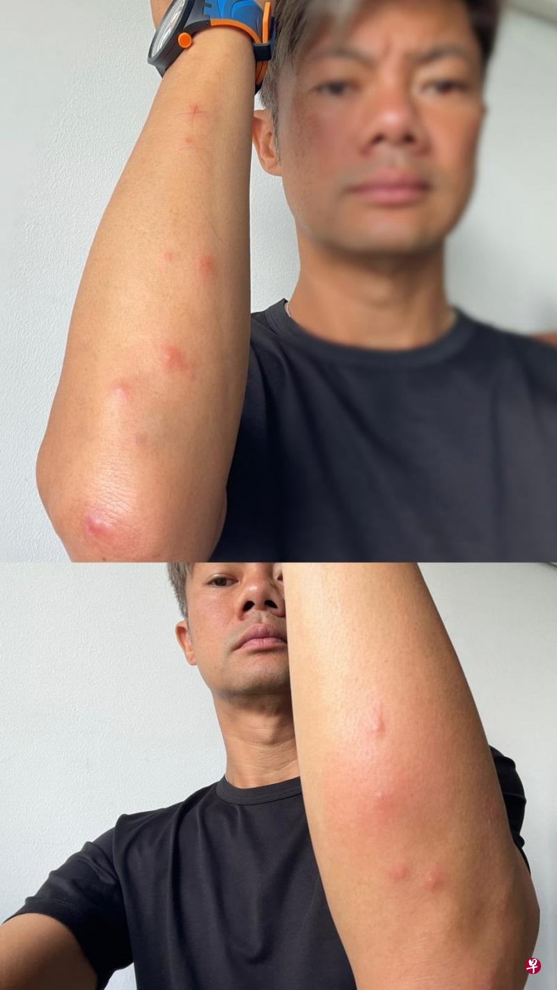 杨君伟到非洲拍节目，被臭虫咬得伤痕累累。（受访者提供）