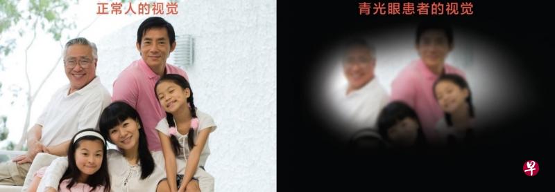 青光眼（glaucoma）是高眼压压迫视神经，引起视神经萎缩所致，如不及时诊治，最终会导致失明。（眼科中心提供）