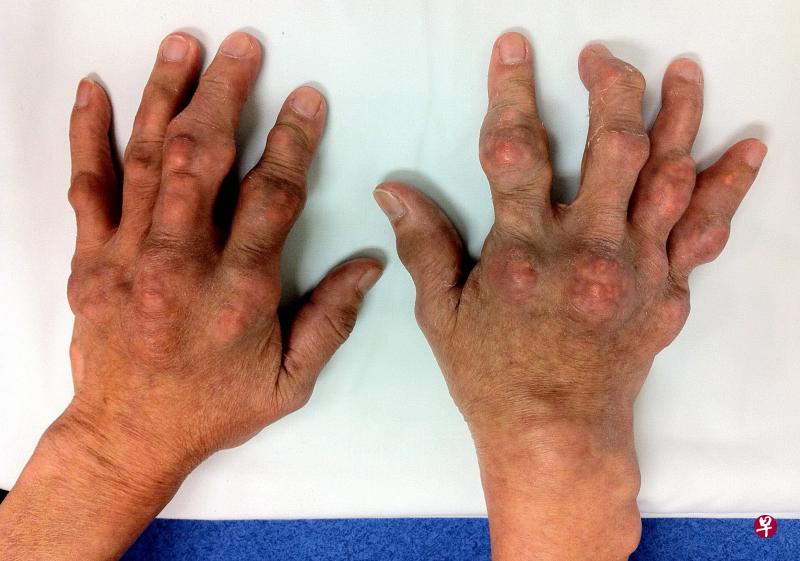 痛风（Gout）的典型症状之一：手上浮凸尿酸肿结。（图＼国大医院）