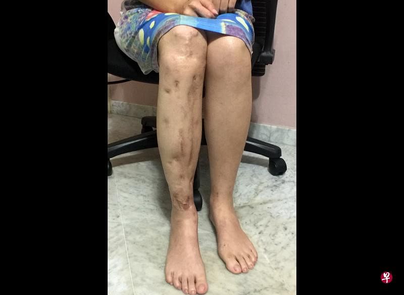 女董事叶文凤的右腿在车祸中受重伤，至今仍未痊愈。