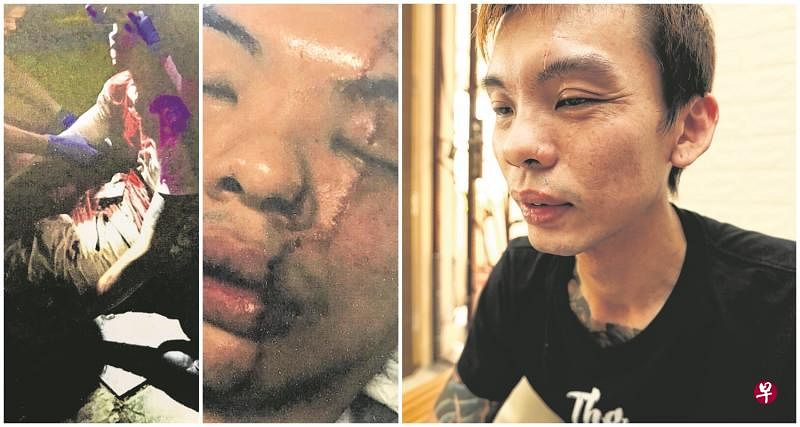 吕霆毅当时全身浴血倒地不起，醒来后发现脸上留有10公分长的疤痕。