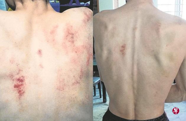 卓先生按摩后回到家中发现背部红肿；消退后（右图）却是一处处的淤青。。（受访者提供）