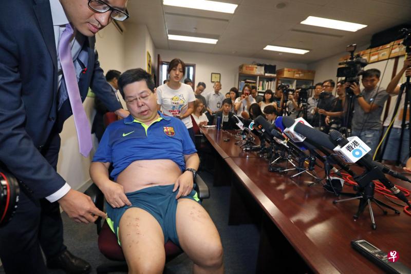 香港民主党成员林子健遭不明身份人士禁锢、殴打与恐吓，他昨天召开记者会诉说遭遇，并展示被人用钉书钉钉上约10个“十字架”的双腿。（路透社）