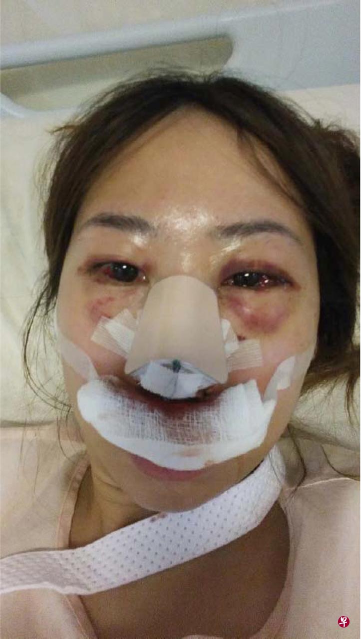 受害人被打后双眼布满血丝、眼眶红肿，脸上包扎着纱布。（总检察署提供） 