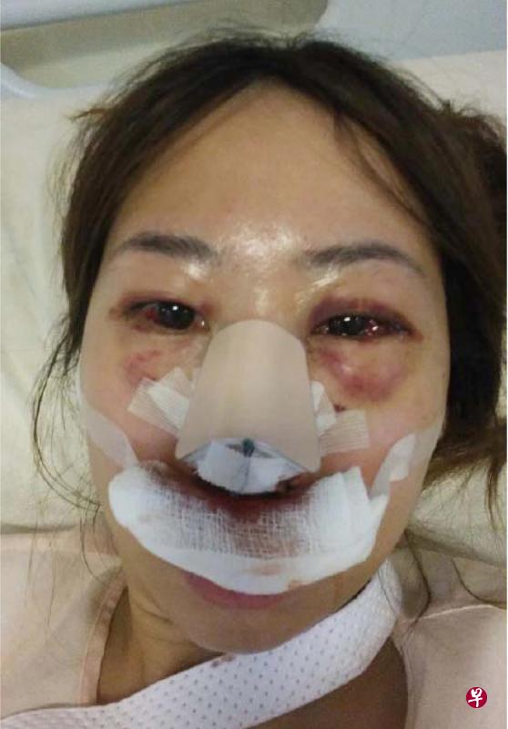 受害人被打后双眼布满血丝、眼眶红肿，脸上包扎着纱布。（总检察署提供）