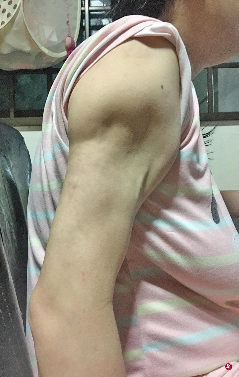 蔡莉莉（译音）说她在2011年时被诊断患上红斑狼疮，患病造成她手臂萎缩、全身疼痛、对光敏感和嗜睡。（档案照）