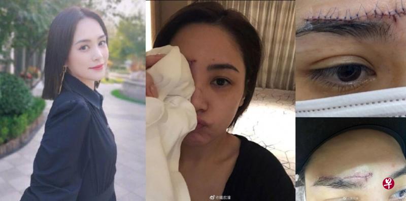 钟欣潼公开伤口照，还自己一个清白。其伤口跟眉毛一样长，左眉上方和鼻梁处也有小伤口（右排图）。（微博图）