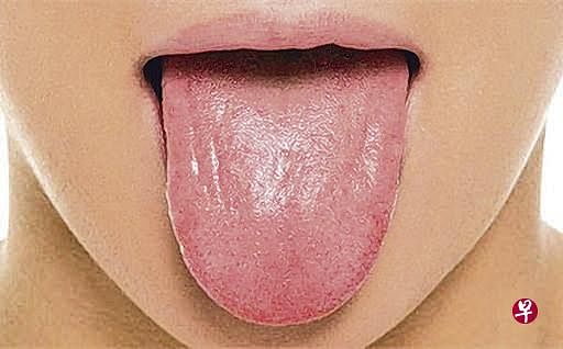 图1：正确的伸舌姿势。淡红色属正常的舌色。