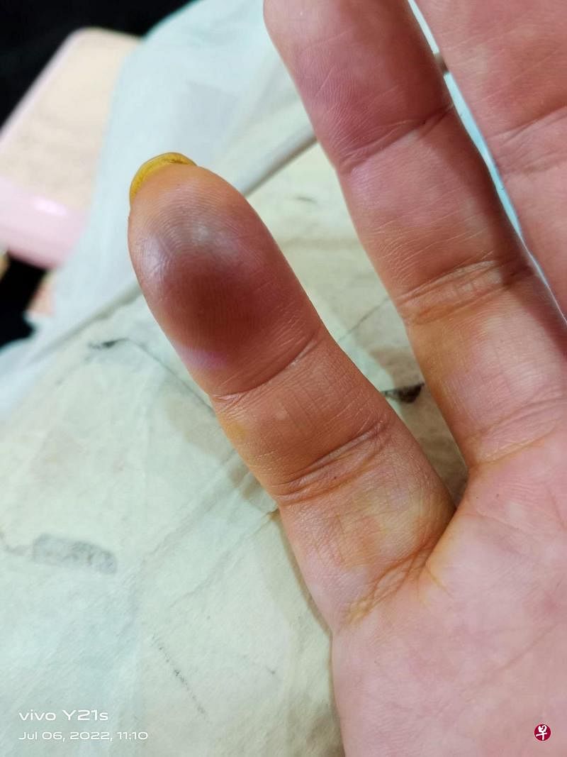 郑福威事后手指红肿，还有淤青。（受访者提供）  