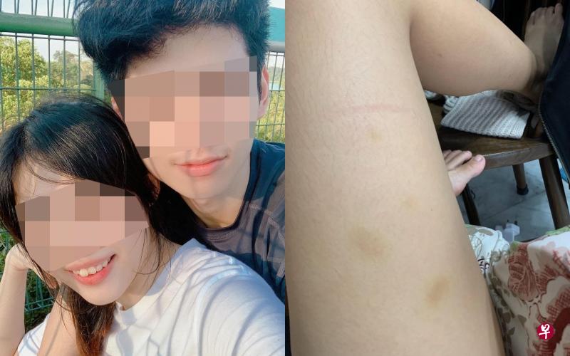 （左图）蔡小姐（左）指与王姓男子（右）交往期间，被多次动粗。（右图）蔡小姐指当年与前男友交往时，曾被他捏到大腿淤青。（受访者提供） 