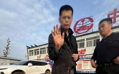 中国央媒新华社两名记者星期四（11月14日）在采访现场被打。图为其中一名记者王文志展示被打出血的右手。（互联网）