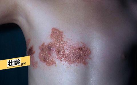 民间俗称的“ 生蛇” ，医学上叫“ 带状疱疹”，这是由水痘带状疱疹病毒引起的急性炎症性皮肤病。（档案照）